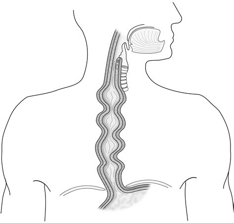 Diffuse Esophageal Spasms Des Treatments Patients And Families Uw