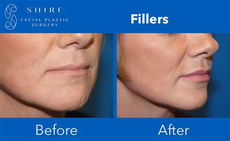 Fillers Before And After Shire Facial Plastic Surgery