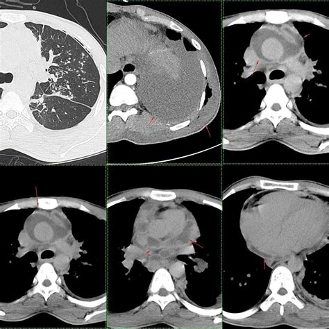 Meaning of loculated pleural effusion medical term. Pic of The Day This is a young patient who has ...