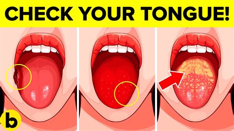 What Your Tongue Says About Your Health Sports Health And Wellbeing