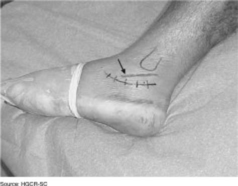 Photograph Showing Cutaneous Incision On The Lateral Approach Of