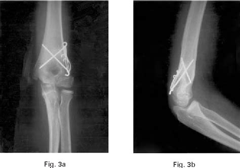 Figure 3 From Reverse V Osteotomy Of The Distal Humerus For The