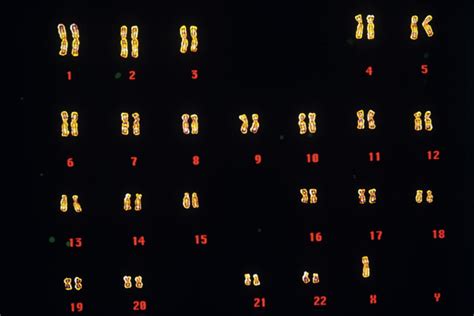 Turners Syndrome Karyotype Photograph By Gjlpscience Photo Library