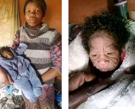 Photos South African Woman Gives Birth To Baby With Rare Genetic