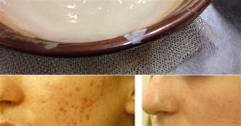 Miracle Homemade Scar Remover For Acne And Dark Spots Healthylife