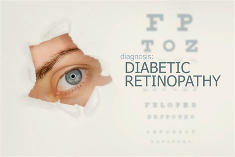 Panretinal Laser Photocoagulation For Diabetic Retinopathy Moorfields