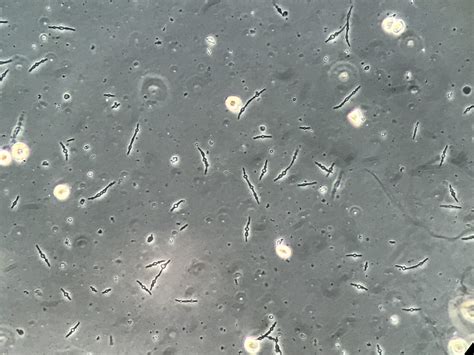 Urine Sediment Of The Month Bacterial Variant Forms Renal Fellow Network