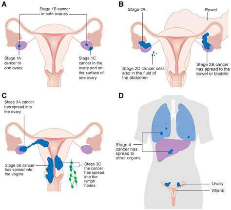 Ovarian Cancer Staging Surgery For Ovarian Cancer Principles And