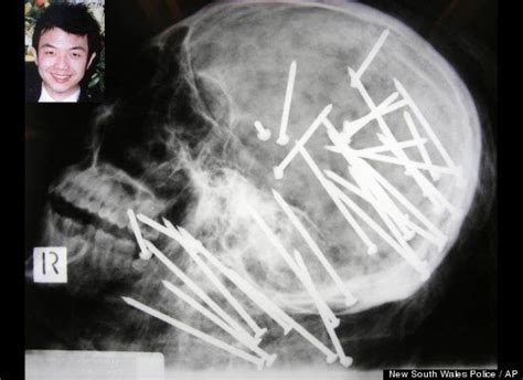 Amazing X Rays 3 Inch Nail In Chicago Man S Brain Latest Medical Wonder