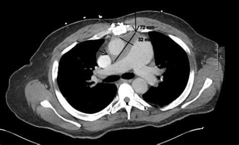 Chest Ct Scan With Iv Contrast Axial View Arrows Showing Download