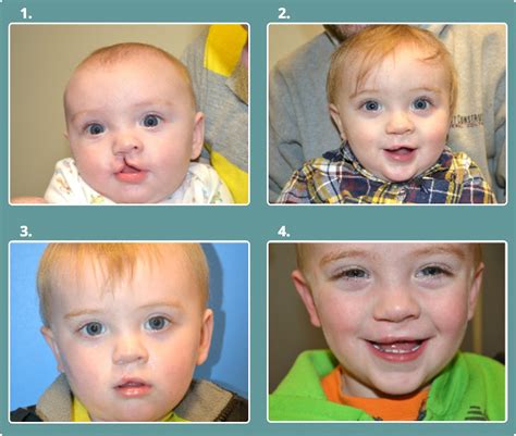 Images Of Cleft Palate Cleft Lip And Palate Raphael A Ason Dmd Md