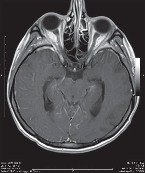 Mri Of The Patient With Cns Involvement In The Course Of Download