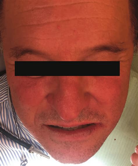 Resolution Of The Facial Pallor 23 Minutes After Intraarterial