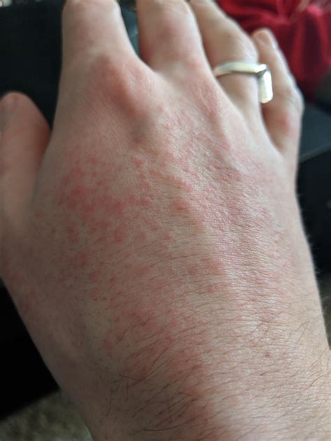 what could this rash be caused by r thebrewery