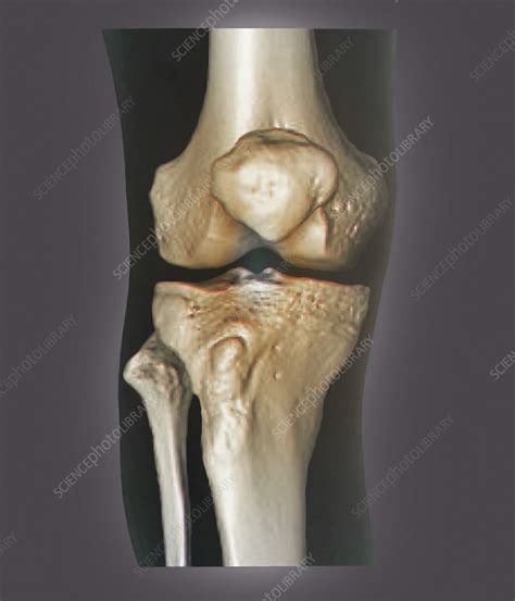Healthy Knee 3d Ct Scan Stock Image C0212004 Science Photo Library