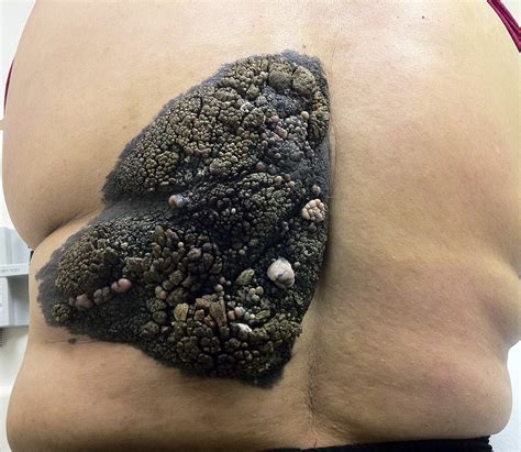 Woman With Bleeding Lesion On Her Back Annals Of Emergency Medicine