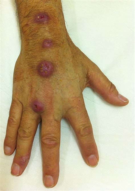 Rose thorn disease, rose gardener's disease. Rose thorn injury | BMJ Case Reports