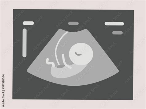 Fetal Ultrasound Flat Illustration Of Ultrasound An Ultrasound