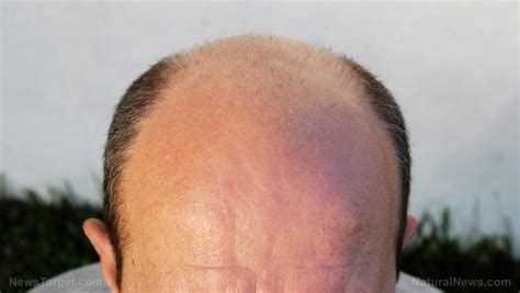 Understanding Baldness Causes Types And Potential Home Remedies