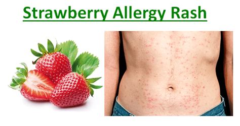 Strawberry Allergy Rash Fruits Facts