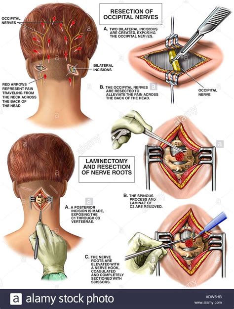 Chronic Migraine Headaches Occipital Neuralgia With Surgical Procedures