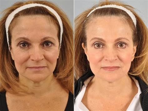 Real Botox Before And After