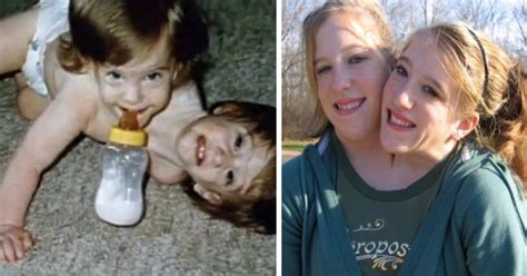 Gémeas siamesas partilham o mesmo corpo há 27 anos
