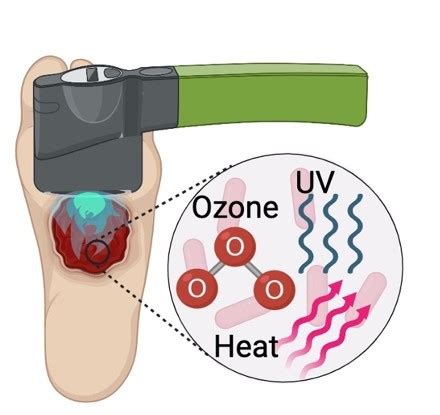 Ozone As A Topical Treatment For Infected Dermal Wounds