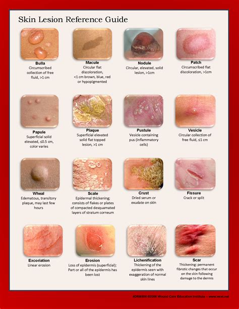 Types Skin Lesion Chart