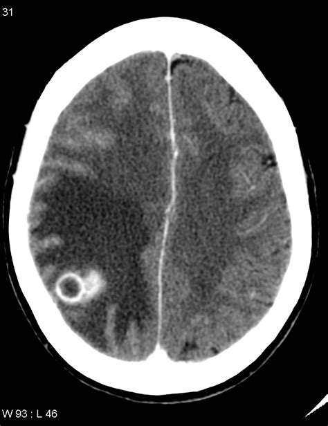 Cerebral Metastasis Lung Cancer Image