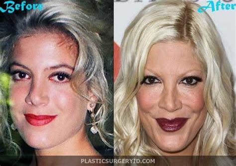 Tori Spelling Plastic Surgery Gone Wrong Celebrities Plastic Surgery