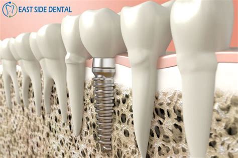36 likes · 43 talking about this. How do Dental Implants Work? The dental implant is placed ...
