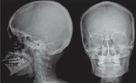 LATERAL AND FRONTAL VIEW OF NORMAL SKULL Buyxraysonline