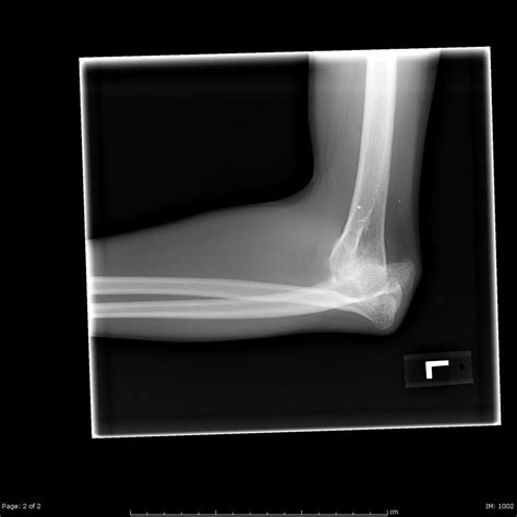 Elbow Dislocation Trauma Orthobullets