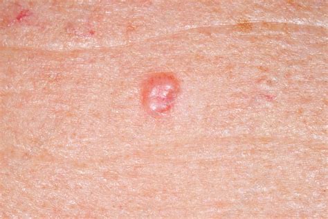 Basal Cell Skin Cancer On Back