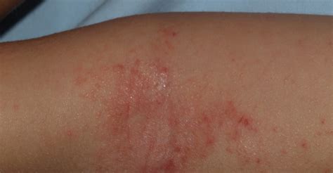 Dermatitis At Pica Cl Nica Dermatol Gica Murcia Openderma