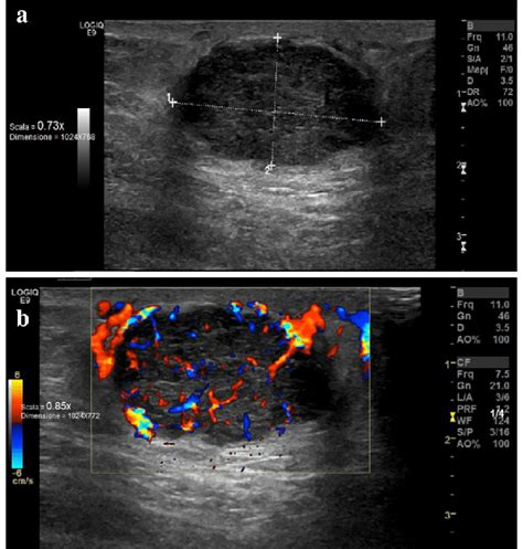 Ultrasound Images Of The Subcutaneous Mass 32 × 18 Mm A Ultrasound