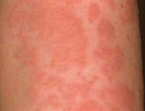 Hives Symptoms Aroundfasr