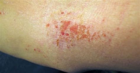 Skin Rashes That Itch Skin Rash Pinterest Eczema Pictures