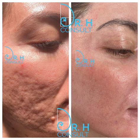 Acne Scarring Laser Treatment Before And After