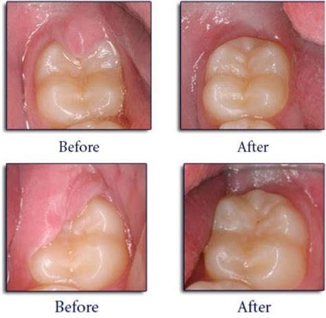 Operculectomy Treatment Services Dental Treatment Services Popular