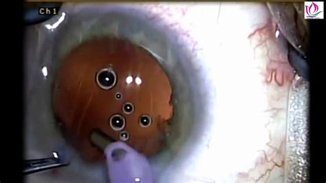 Discover The Process Of Cataract Surgery Eye Surgery Youtube