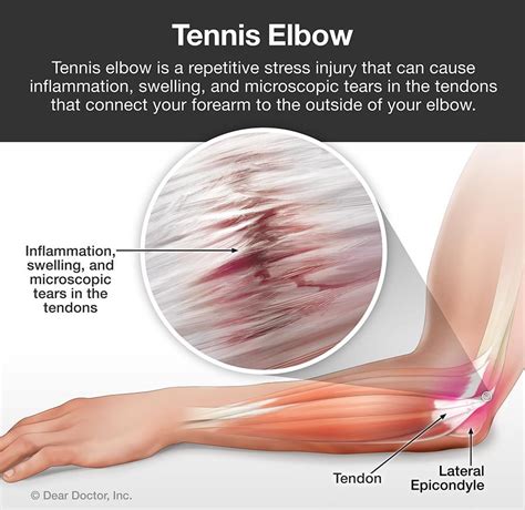 Tennis Elbow Chiropractor In Liberty Ny Spina Chiropractic Office