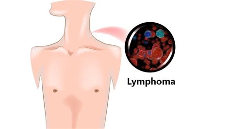 Lymphoma Causes Symptoms Risk Factors Diagnosis And Treatment