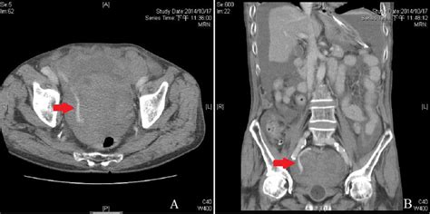 A Contrast Enhanced Ct Pelvis Axial View Shows Contrast Extravasation