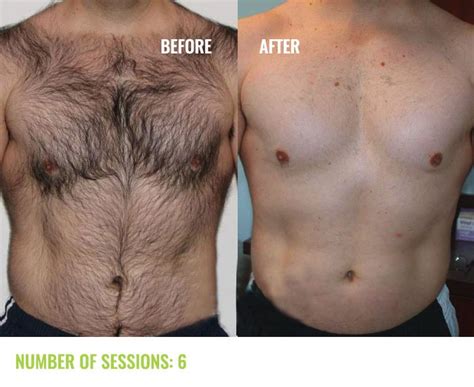 There are a few guidelines and tips you should know about before booking an appointment. Soprano Ice Laser Hair Removal Before and After Results ...