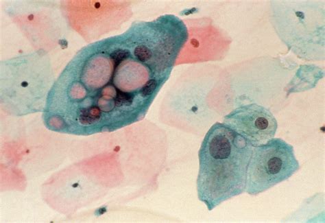 Lm Of Cervical Smear Chlamydia Infection Photograph By Science Photo