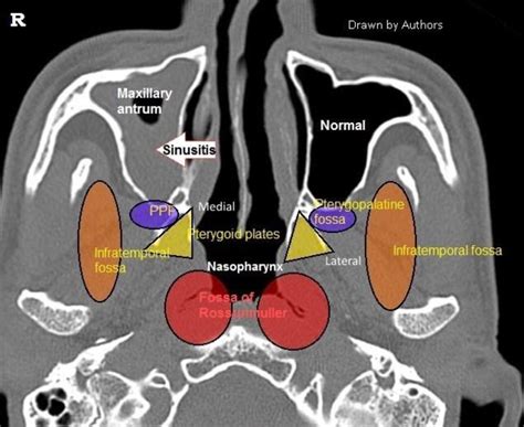 Figure 1 From Radiological Profiles Of Nasopharyngeal Anatomy As Seen