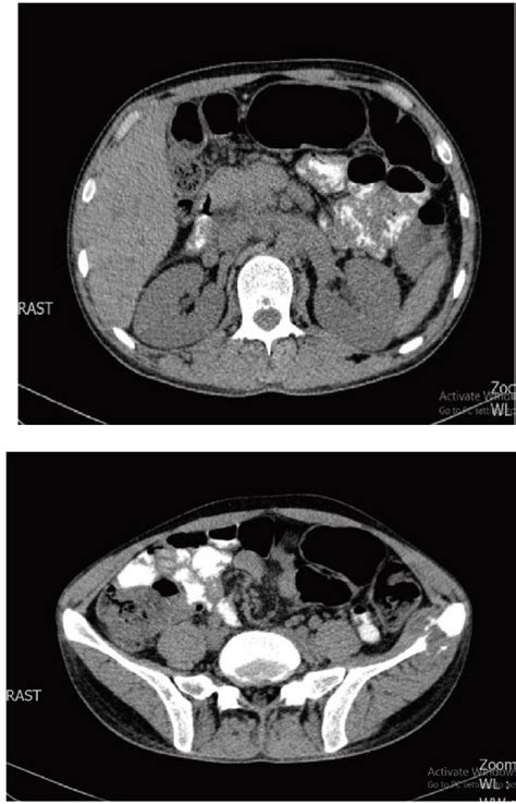 Abdominopelvic Ct Scan With And Without Contrast February 2018
