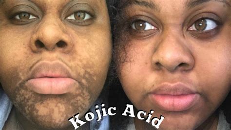 Kojic Soap Side Effects
